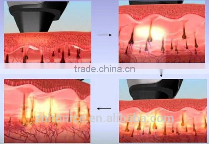 Hot sale diode laser 808nm deplication hair removal Y8