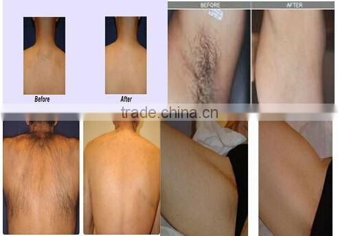 Y9D-Ydel promotion!!! perfect 808 nm diode laser hair removal machine for sale