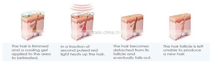 Y9D-Ydel promotion!!! perfect 808 nm diode laser hair removal machine for sale