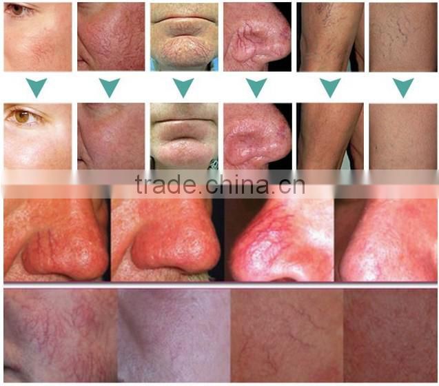 RBS02- Rayna Endovenous Veins laser treatment 980nm diode laser