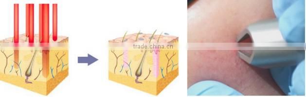 980nm Diode Laser Spider Vein Removal Machine Rbs02