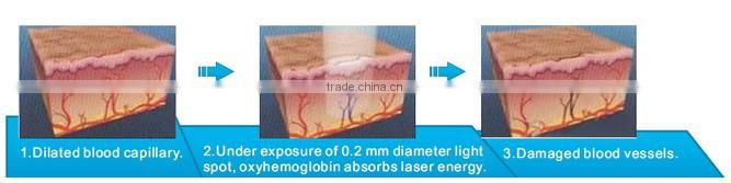 RBS02- Rayna Endovenous Veins laser treatment 980nm diode laser