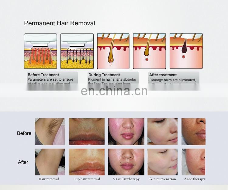 Portable 2 In 1 IPL Shr System New Elight Hair Removal/Permanent Hair Removal Machine