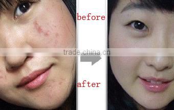 Best OEM acne cream treatment