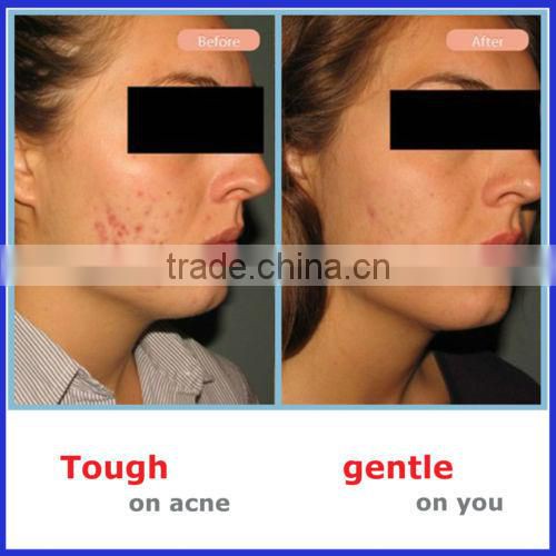 Best OEM acne cream treatment