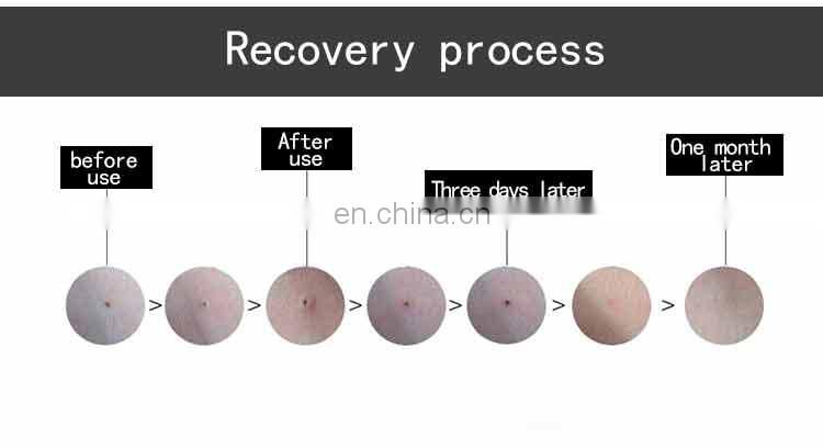 Skin rejuvenation /multifunctional plasma pen / beauty device